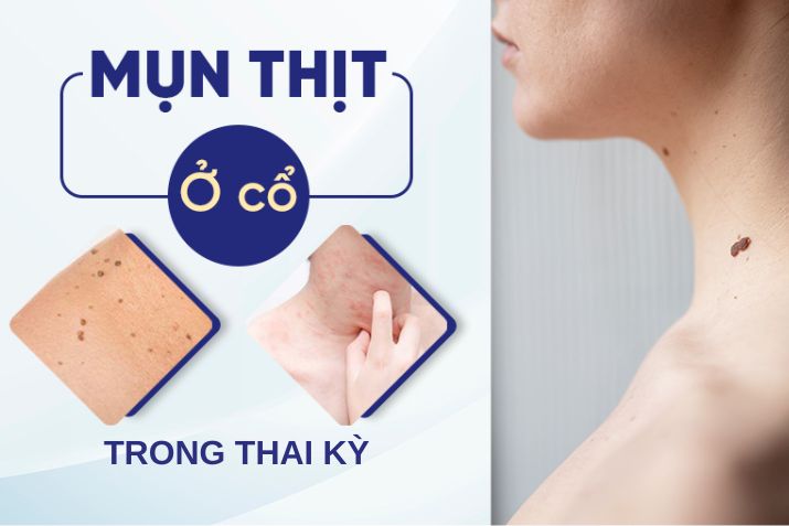 Nổi mụn thịt ở cổ trong thai kỳ có nguy hiểm không?
