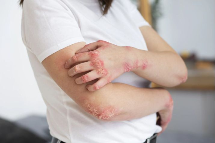 Có những loại bệnh nấm da nào? Ở đây có cách điều trị nấm da hiệu quả