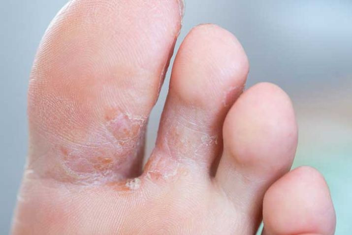 Cần biết những gì về nấm da chân để điều trị thật hiệu quả?