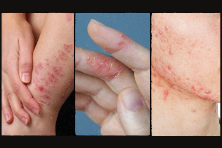 Nhận biết viêm da cơ địa - Hình ảnh viêm da cơ địa người lớn