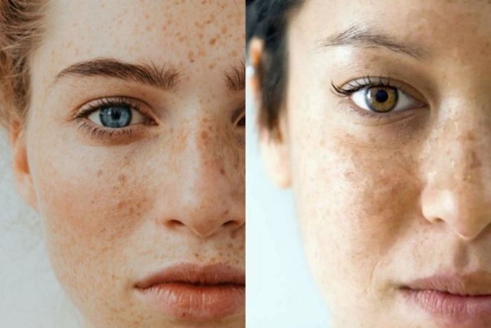 Tìm hiểu về nám tàn nhang ở phụ nữ tiền mãn kinh
