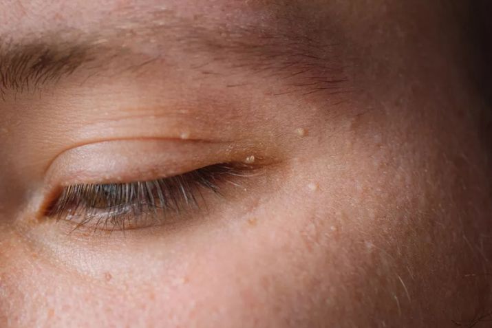 Mụn thịt ở mắt có lây lan không? Phải làm sao để ngăn ngừa thật hiệu quả?
