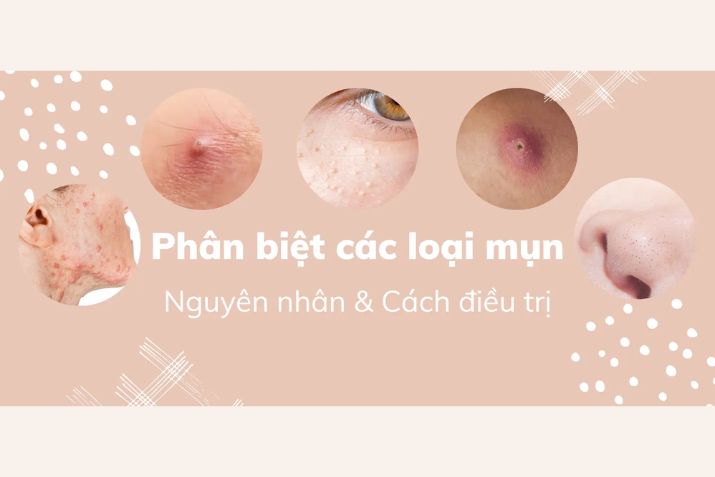 Cách phân biệt các loại mụn viêm và không viêm
