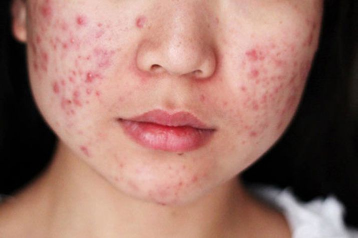 Vì sao cần khám da liễu khi bị mụn viêm?