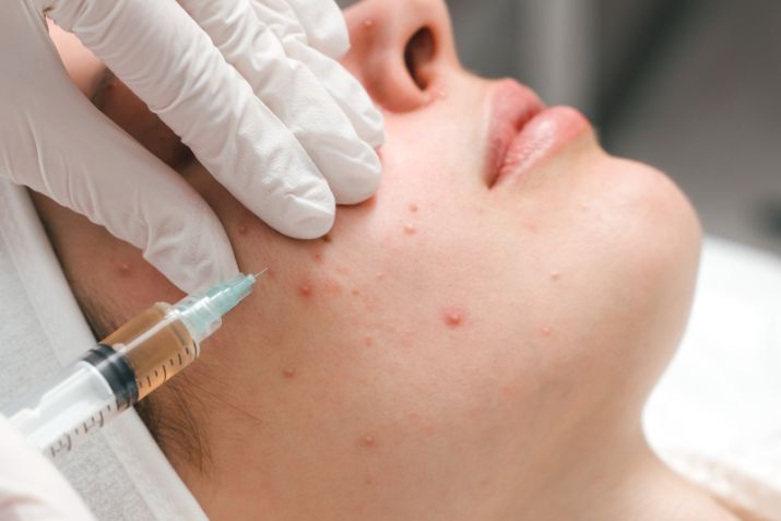 Mách bạn địa chỉ tiêm meso trị mụn tại phòng khám da liễu quận Bình Thạnh