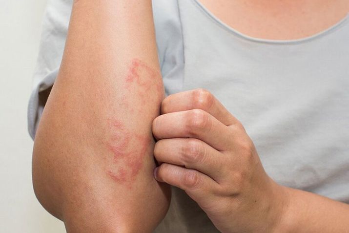 Lưu ngay địa chỉ điều trị viêm da tại phòng khám da liễu quận Bình Thạnh