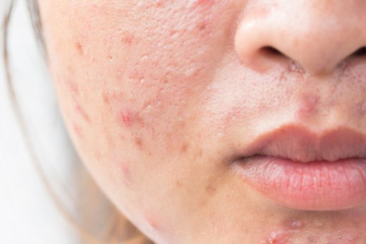 Nặn mụn xong cần phải làm gì để không có thâm sẹo?