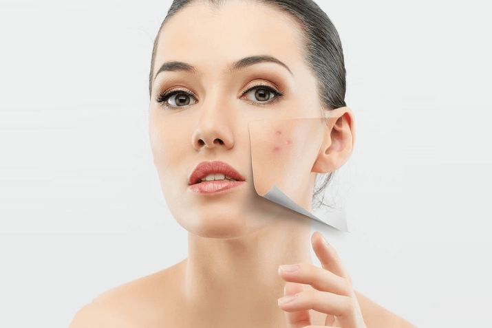 Mách bạn 10 bí quyết phục hồi da nhanh chóng sau khi nặn mụn