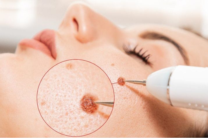 Xóa nốt ruồi không để lại sẹo bằng Laser Fractional CO2 - Giải pháp an toàn và được ưa chuộng