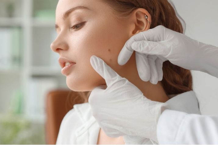 Xóa nốt ruồi không đơn thuần là làm đẹp - mà là lấy lại sự tự tin!
