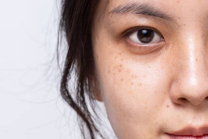 Giải pháp trị nám, sạm, tàn nhang tại Pro Skin, giúp da sáng lên từ gốc