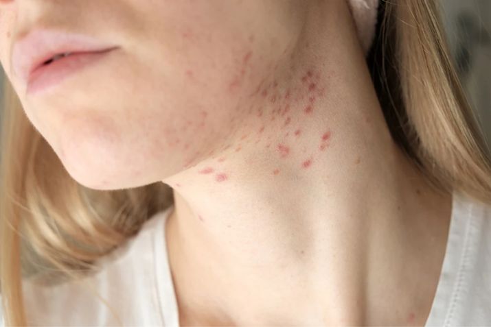 Góc hỏi đáp: Nổi mụn ở cổ có liên quan đến nội tiết tố không?