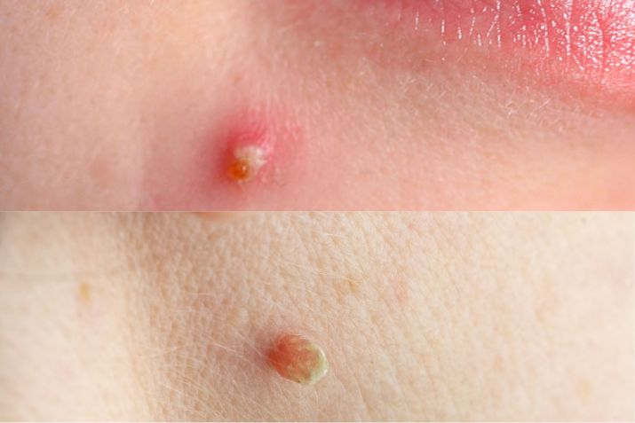 Mụn và mụn thịt: Sự khác biệt và cách điều trị an toàn bạn cần biết