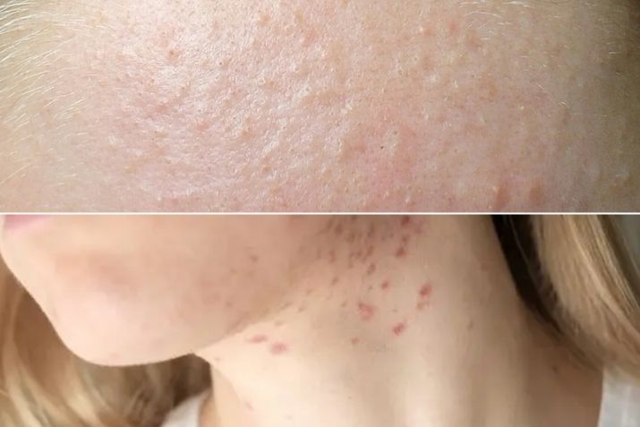Mụn ẩn, nổi mụn ở cổ là dấu hiệu gì? Khi nào nên đi khám da liễu?