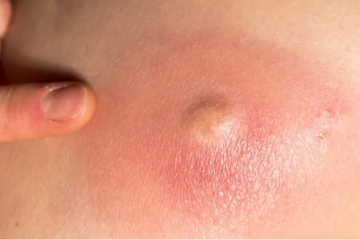 Những hiểu lầm về mụn nhọt có thể bạn chưa biết – Cẩn thận với thói quen dễ gây mụn nhọt