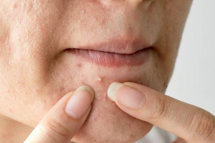 Tự nặn mụn trứng cá tại nhà có an toàn không? Những sai lầm phổ biến khiến tình trạng viêm nặng hơn?