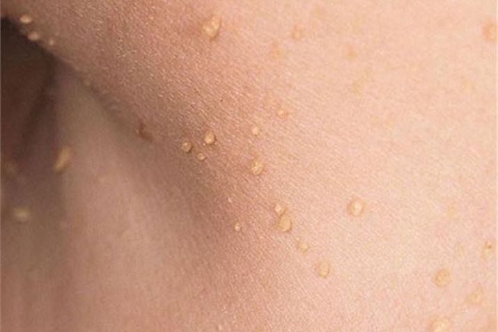 Mụn thịt dư có lây không? Sự thật bạn cần biết để tránh nhầm lẫn