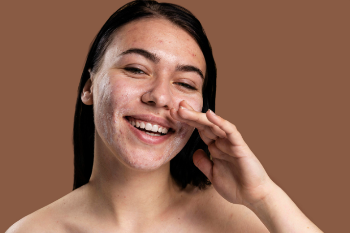 Thâm mụn hình thành từ đâu? Top 5 cách đối phó với mụn thâm.
