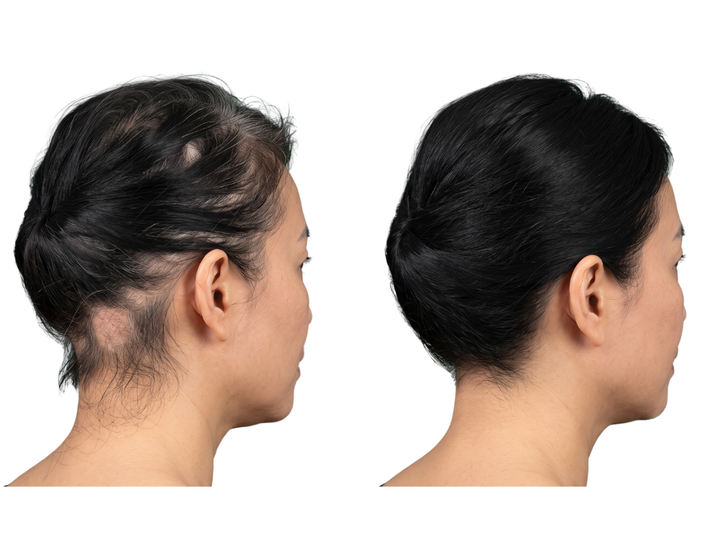 Sau điều trị