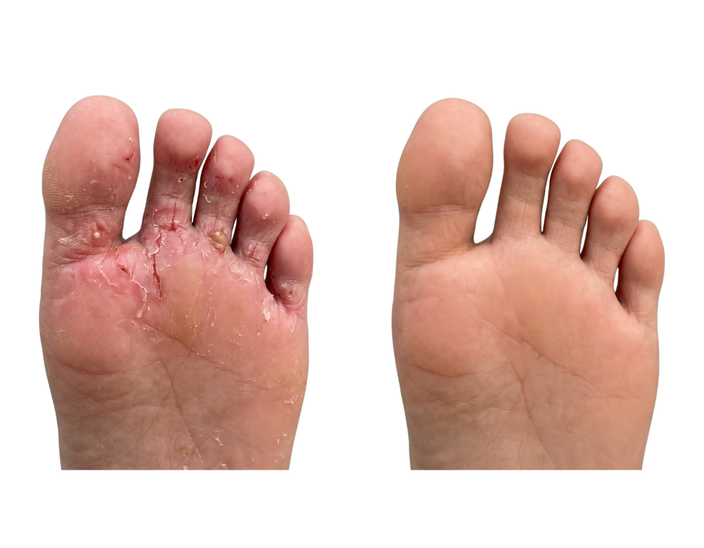 Sau điều trị
