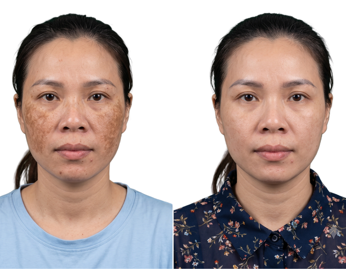 Sau điều trị
