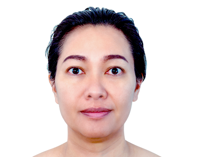Sau - Hình ảnh khách hàng trước và sau điều trị