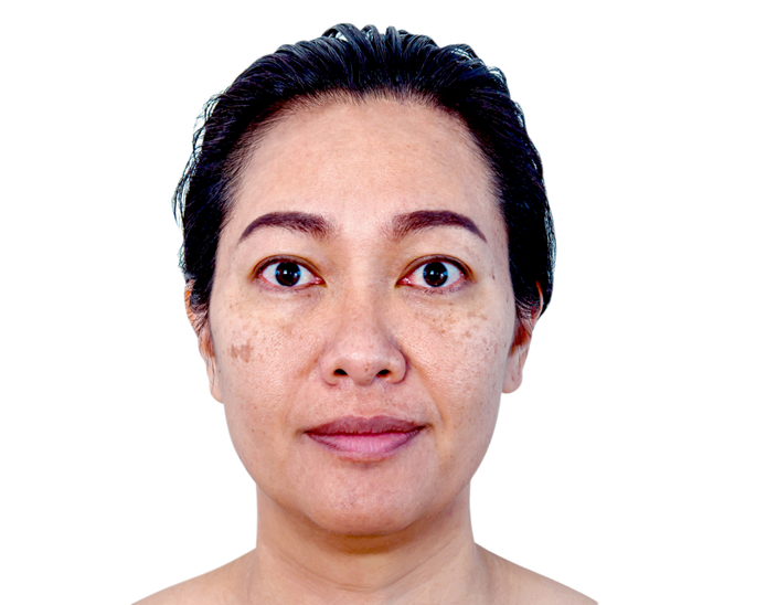 Trước - Hình ảnh khách hàng trước và sau điều trị