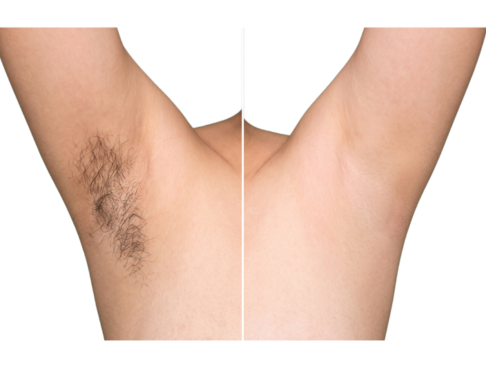 Sau - Hình ảnh trước và sau điều trị