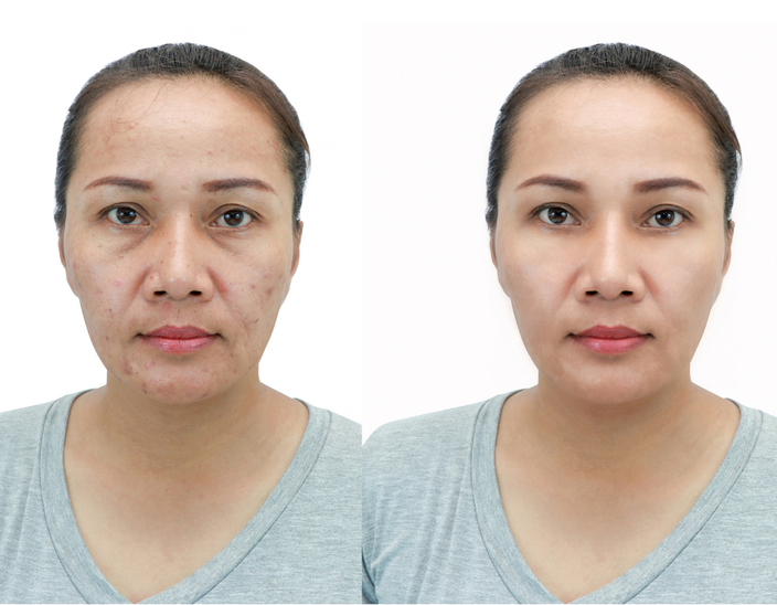 Sau — Hiệu quả điều trị trẻ hóa da