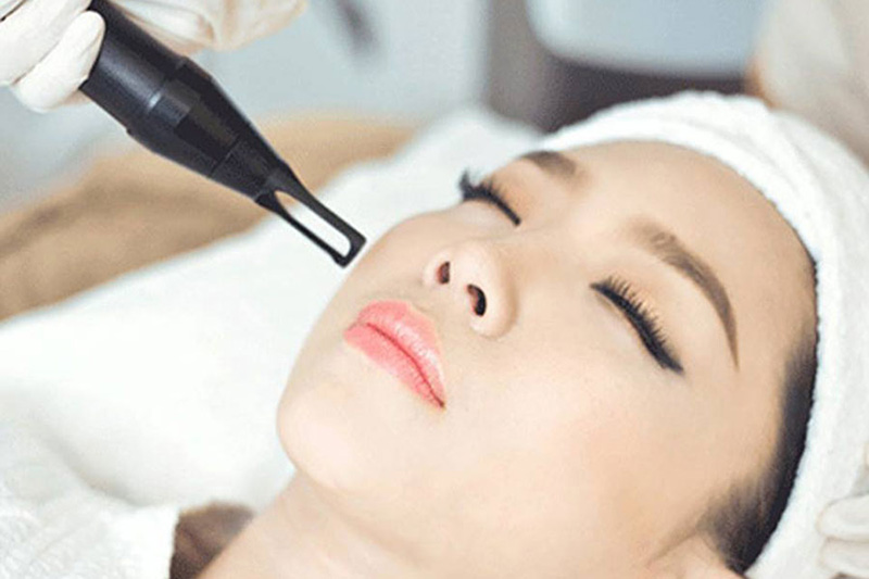 Đốt mụn thịt bằng Laser Fractional CO2