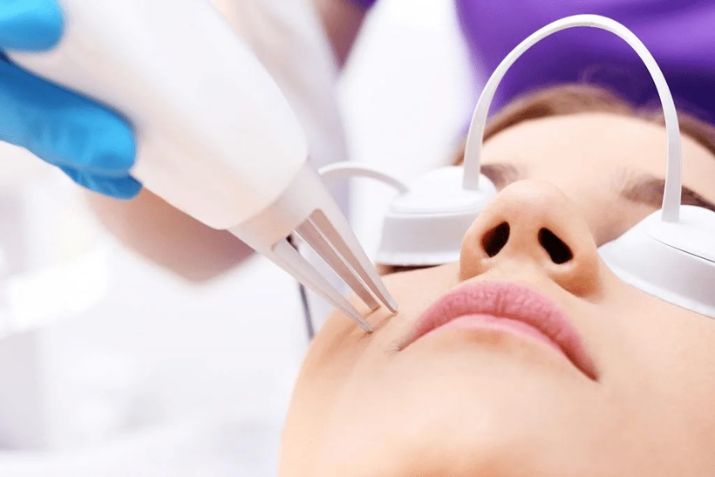 Trị mụn thịt bằng laser fractional co2