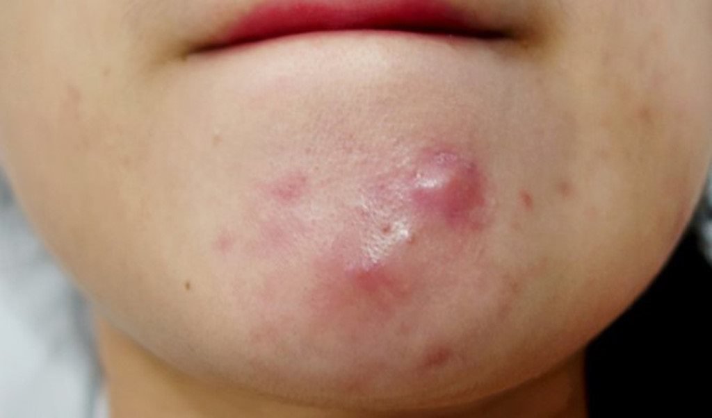 Mụn bọc tr&ecirc;n mặt