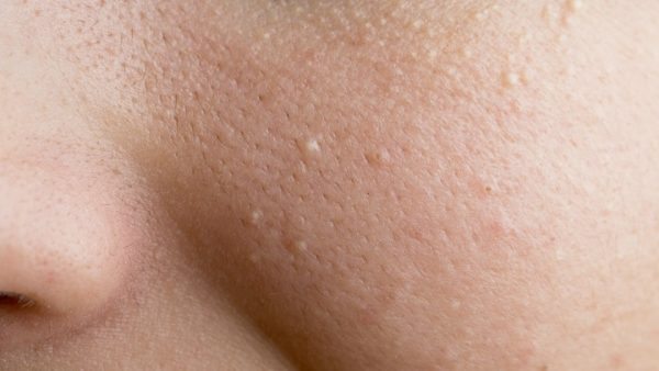 Mụn đầu trắng thường nằm k&iacute;n v&agrave; s&acirc;u dưới da