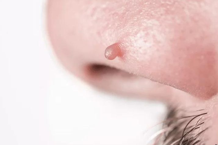 Mụn thịt ở mũi l&agrave; g&igrave;