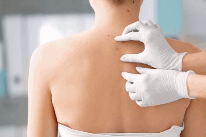 Mụn thịt trên lưng