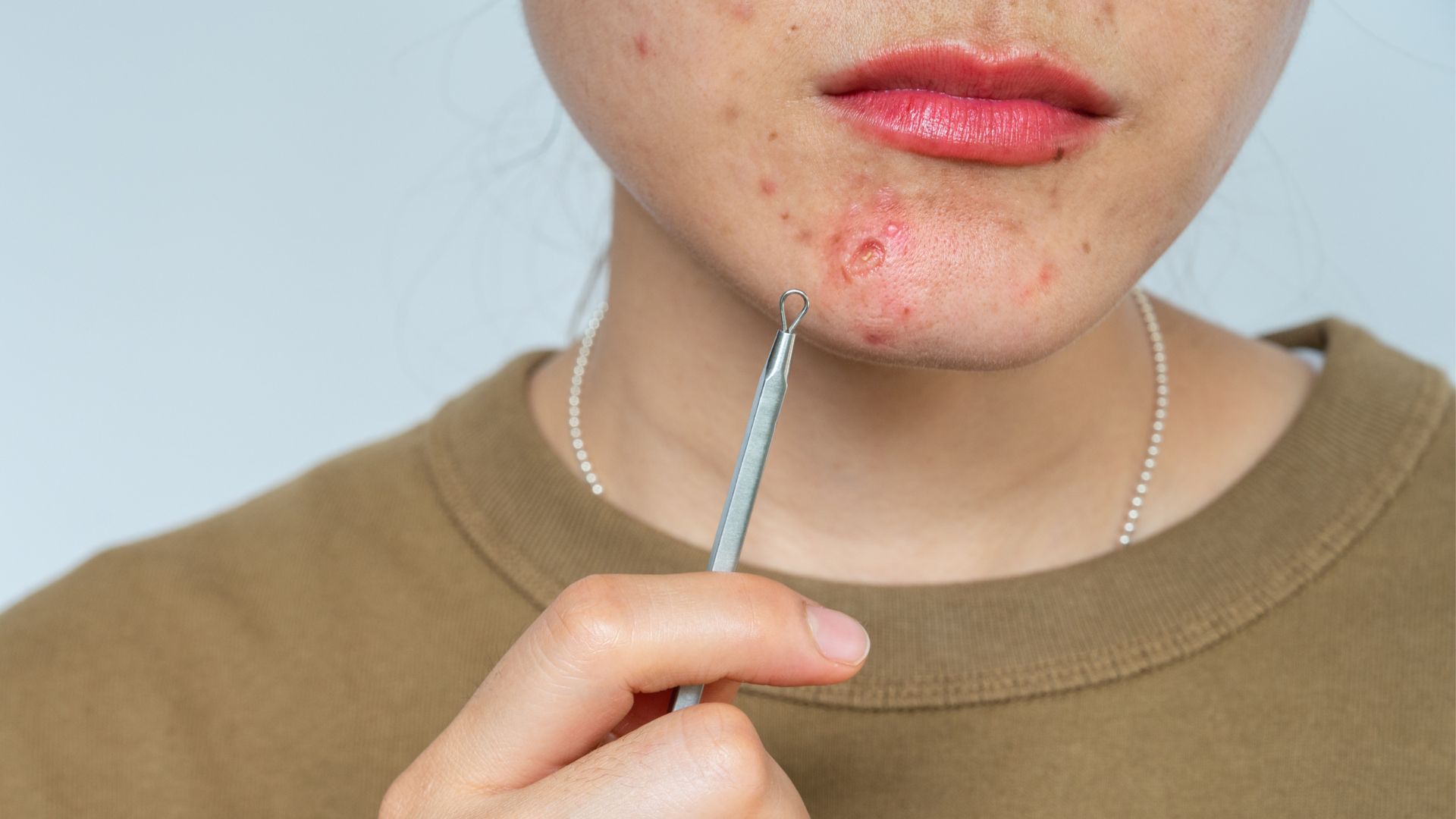 Nặn mụn bọc bằng c&acirc;y nặn mụn để lại th&acirc;m v&agrave; hằn sẹo