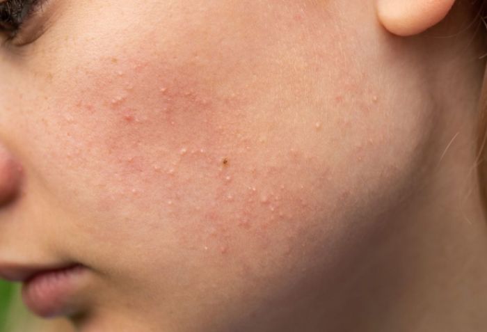 Dấu hiệu nhận biết mụn ẩn