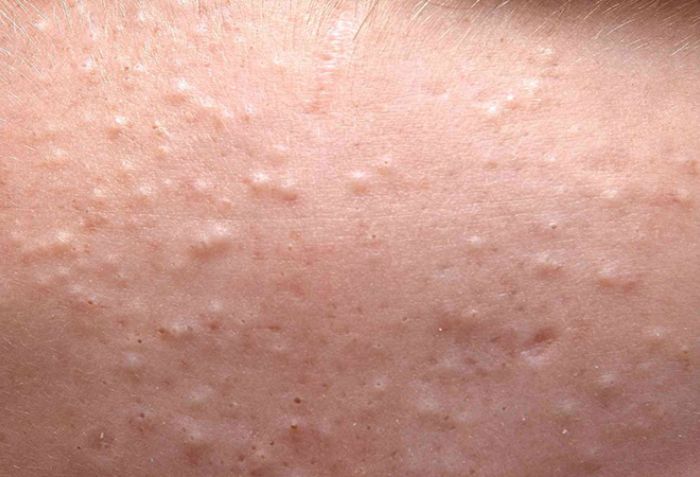 Những ai n&ecirc;n v&agrave; kh&ocirc;ng n&ecirc;n thực hiện peel da?
