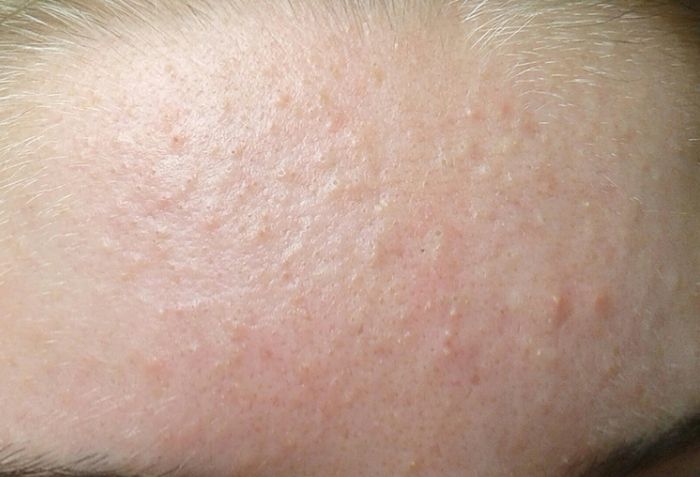Mụn ẩn l&agrave; g&igrave; v&agrave; v&igrave; sao lại xuất hiện?