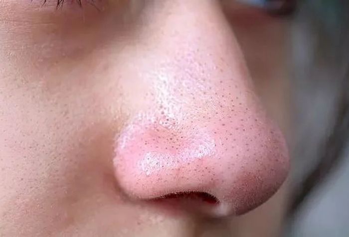 Mụn đầu đen l&agrave; g&igrave;?