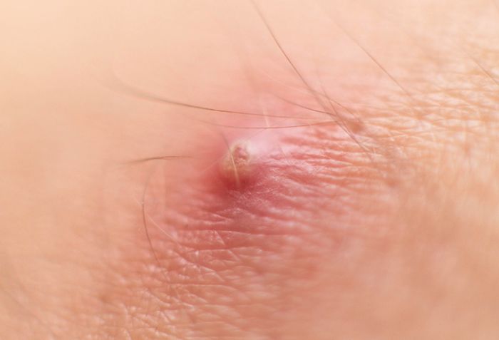 Mụn nhọt l&agrave; g&igrave;?