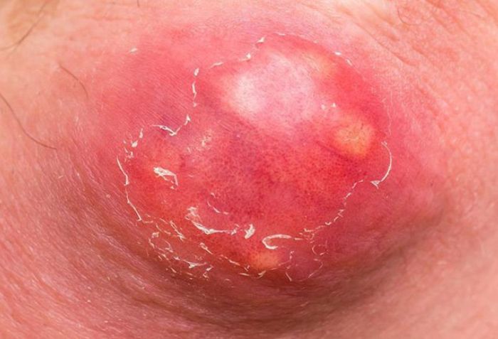 Mụn nhọt lớn, đau, sốt cao c&oacute; nguy cơ biến chứng
