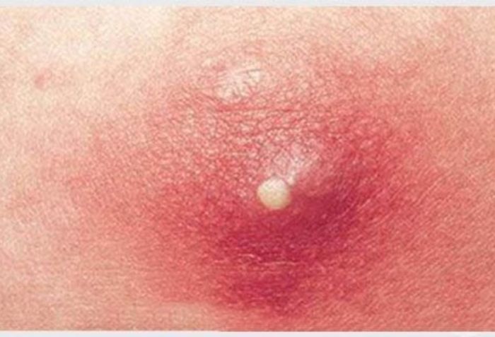 Triệu chứng của mụn nhọt