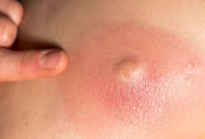 Triệu chứng của mụn nhọt