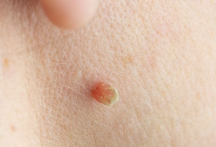 Mụn thịt l&agrave; g&igrave;? Nguy&ecirc;n nh&acirc;n g&acirc;y ra mụn thịt