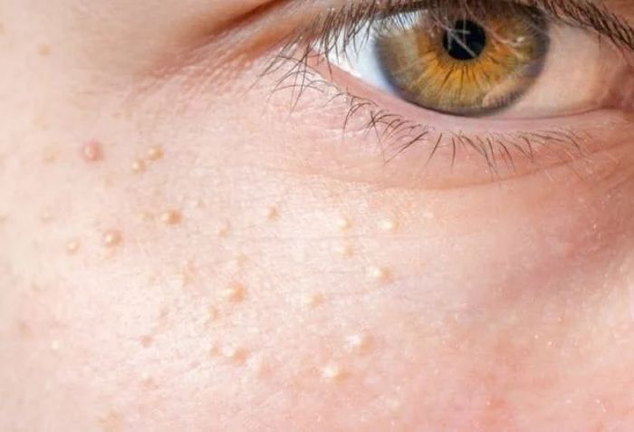 Thế n&agrave;o l&agrave; mụn thịt?