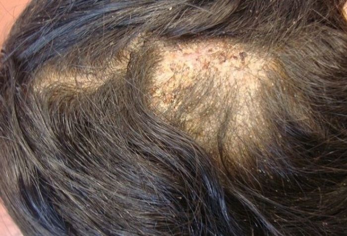 C&aacute;c bệnh l&yacute; thường gặp khi kh&aacute;m da liễu