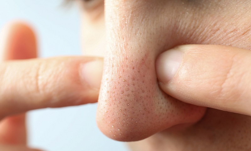 Dùng tay trực tiếp nặn mụn đầu đen