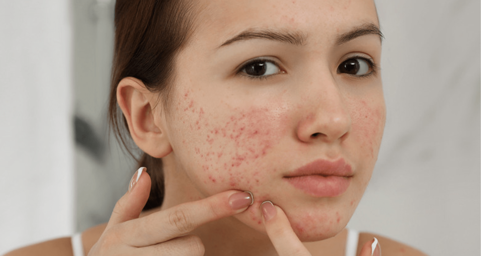 Th&oacute;i quen tự tay nặn mụn để loại bỏ cồi nhanh