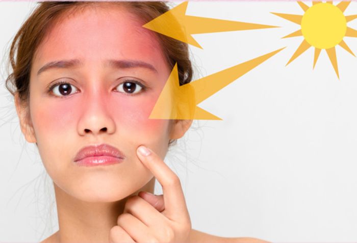 Tăng sự nhạy cảm với &aacute;nh nắng mặt trời
